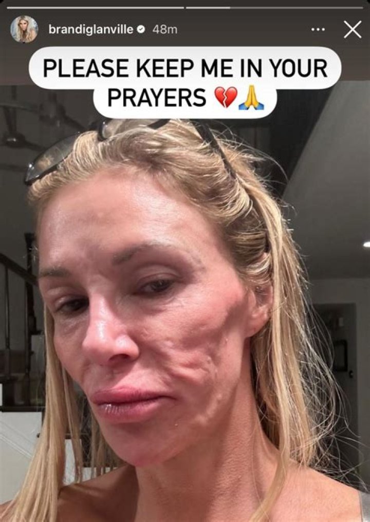 Brandi Glanville Updates Fans After Being Hospitalized With Spider Bite