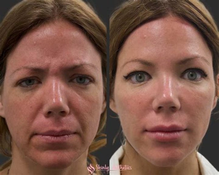 Carol Kirkwood Botox Plastic Surgery Before And After Photos