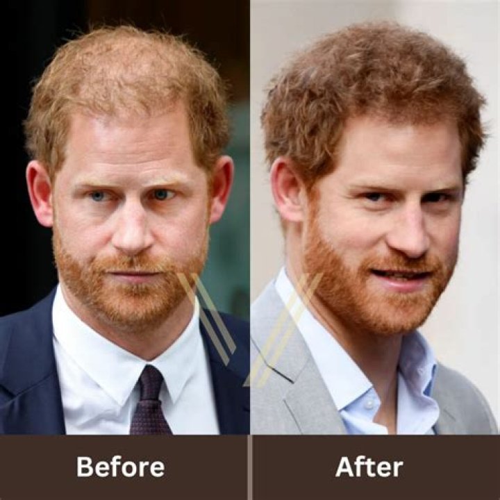 Prince Harry losing his hair could be from 'tension with William and Charles'